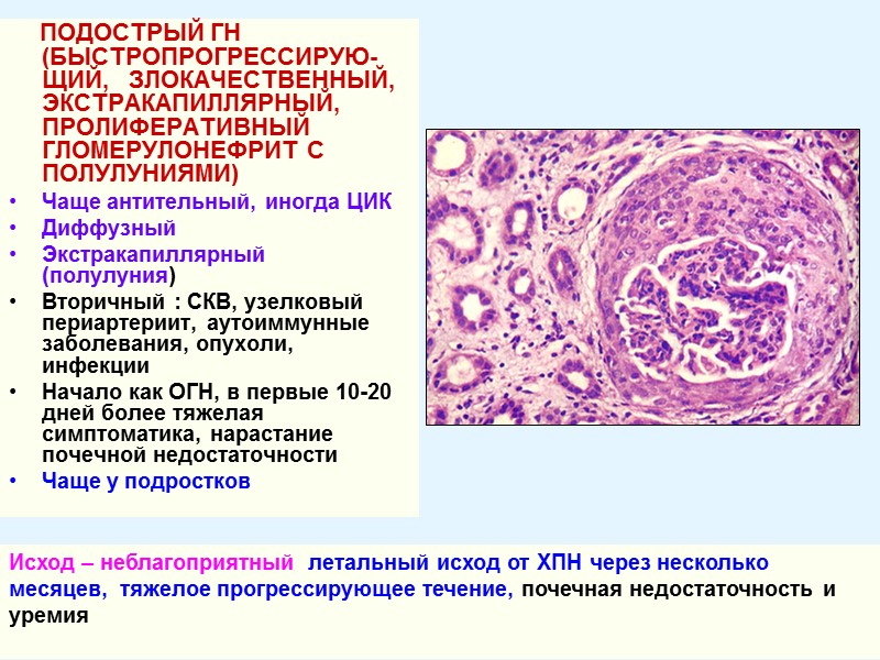 ПОДОСТРЫЙ ГН (БЫСТРОПРОГРЕССИРУЮ-ЩИЙ,   ЗЛОКАЧЕСТВЕННЫЙ, ЭКСТРАКАПИЛЛЯРНЫЙ, ПРОЛИФЕРАТИВНЫЙ ГЛОМЕРУЛОНЕФРИТ С ПОЛУЛУНИЯМИ) Чаще антительный, иногда